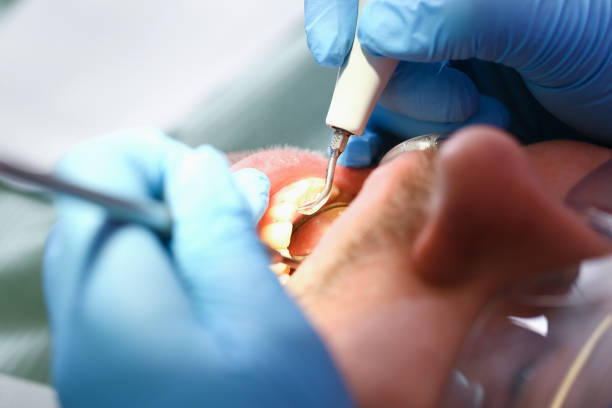 Best Emergency Dental Extractions in St Joseph, MO